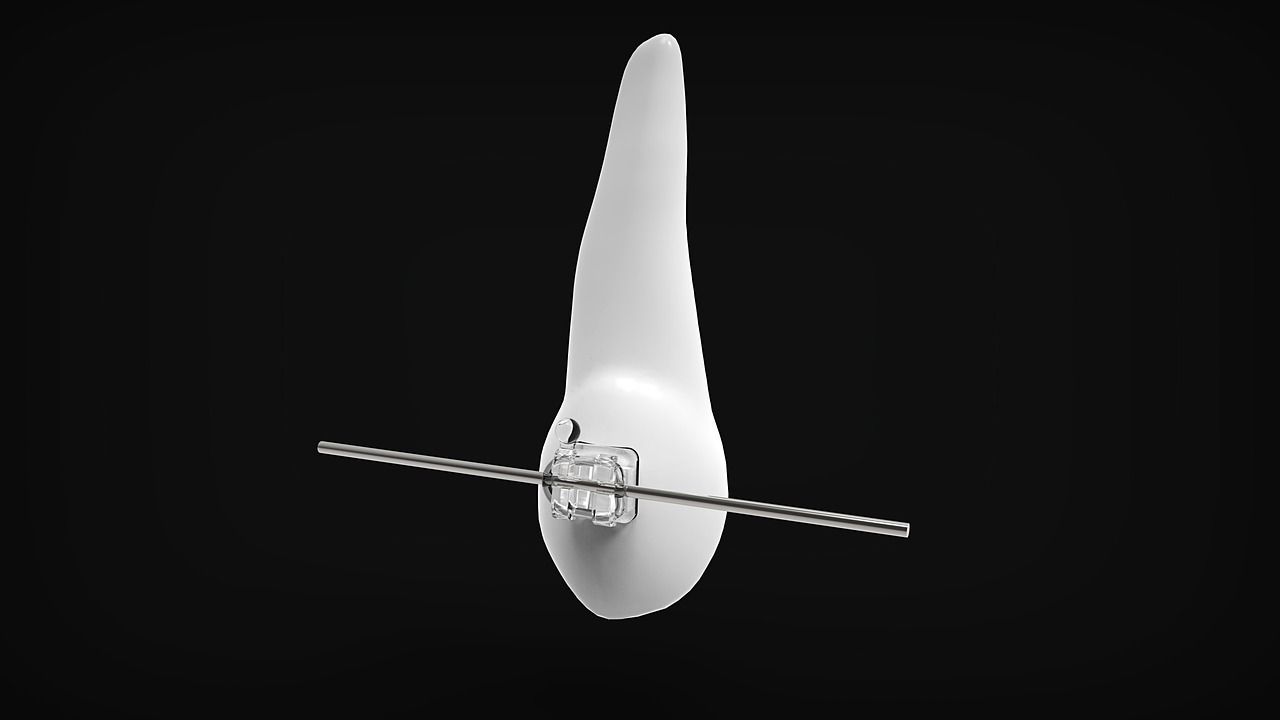 Diente con soporte metálico y alambre, sobre fondo negro.