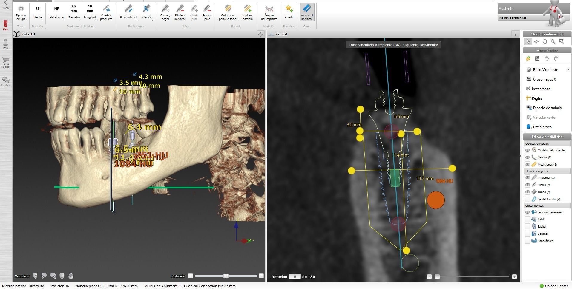 Representación 3D de un maxilar con implantes dentales planificados. Las pantallas muestran secciones transversales y la colocación virtual del implante.