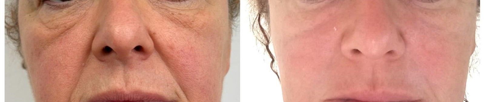Dos vistas faciales en primer plano, una que muestra arrugas y la otra con una piel más suave.