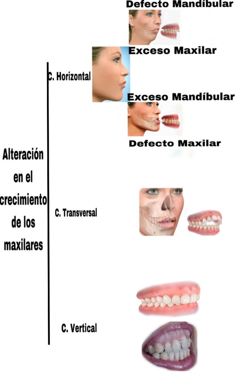 Diagrama que muestra las alteraciones del crecimiento de la mandíbula, clasificadas en horizontales, transversales y verticales, con ejemplos faciales relacionados.