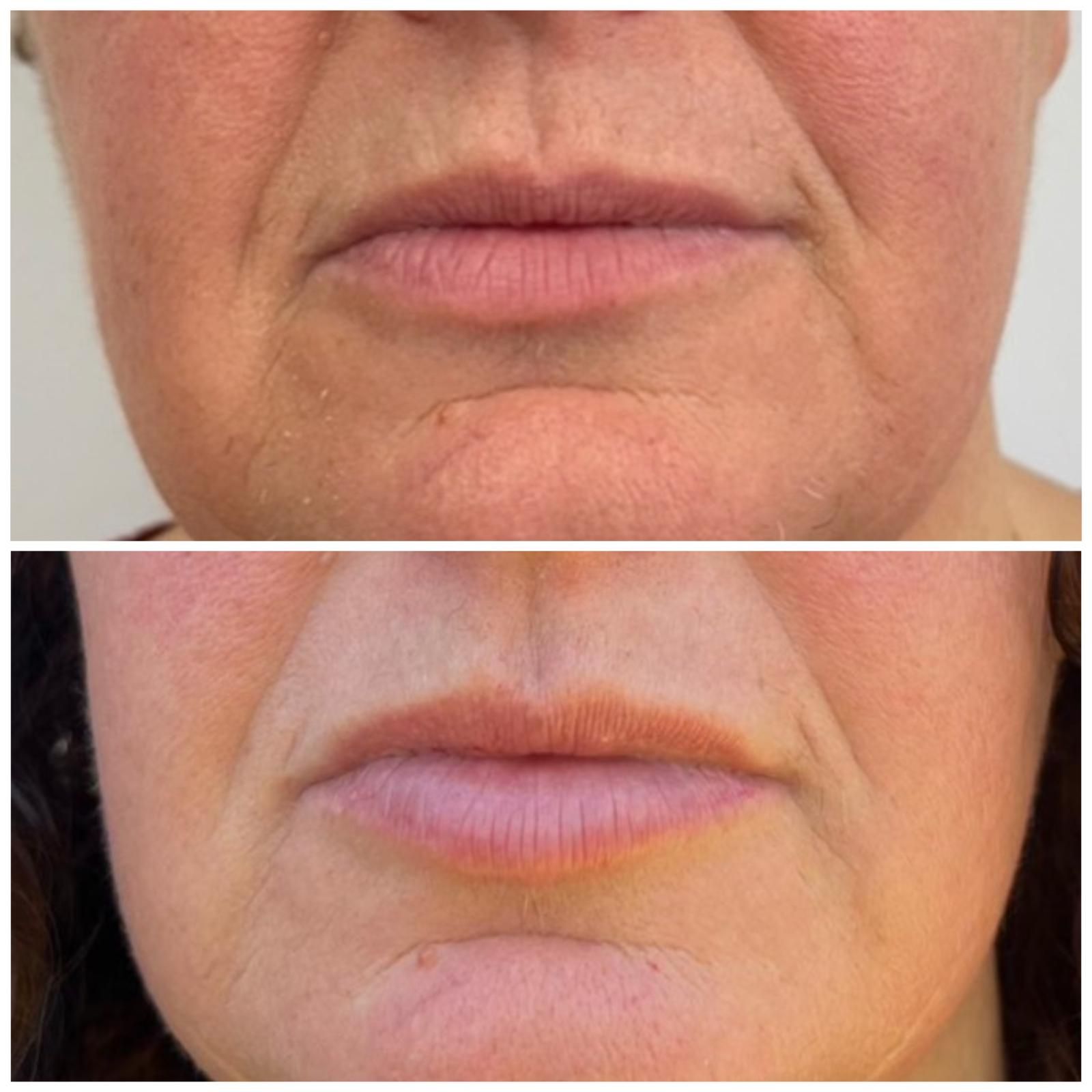 Fotografías de antes y después de la boca y el mentón de una persona, que muestran una reducción de arrugas y labios más voluminosos.