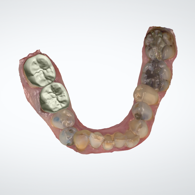 Full Zircon post empreinte optique