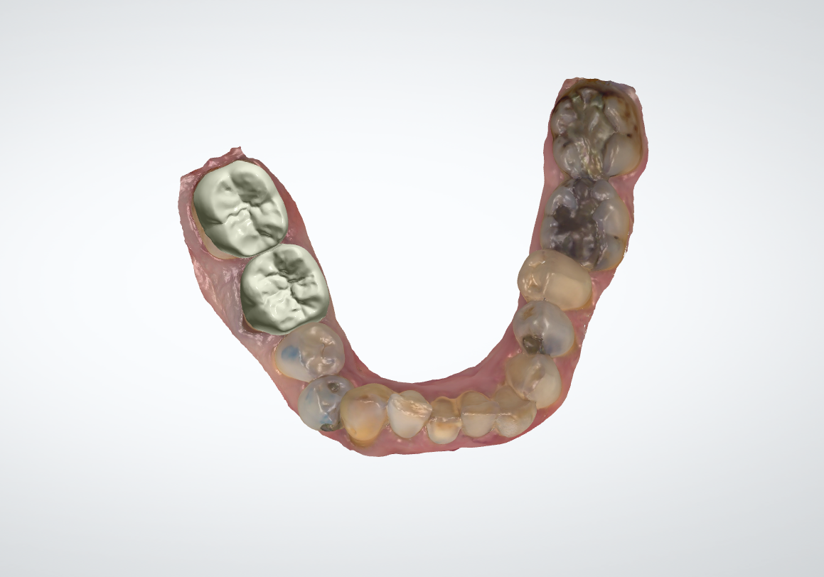 Full zircon post empreinte optique