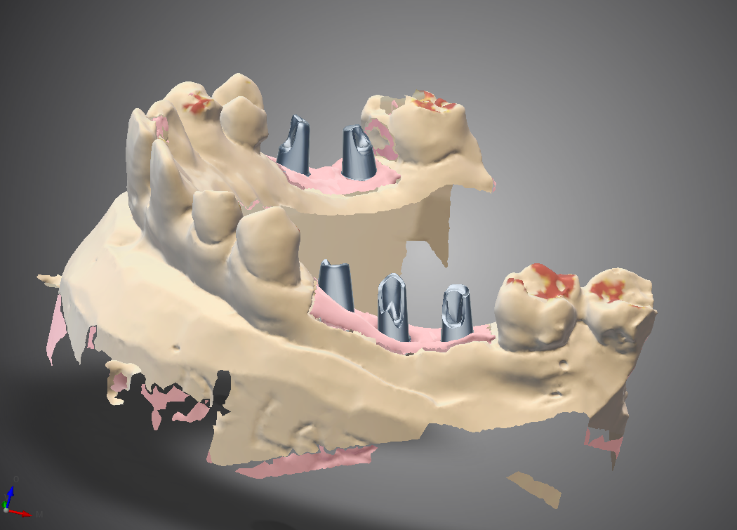 Faux moignon implantaire