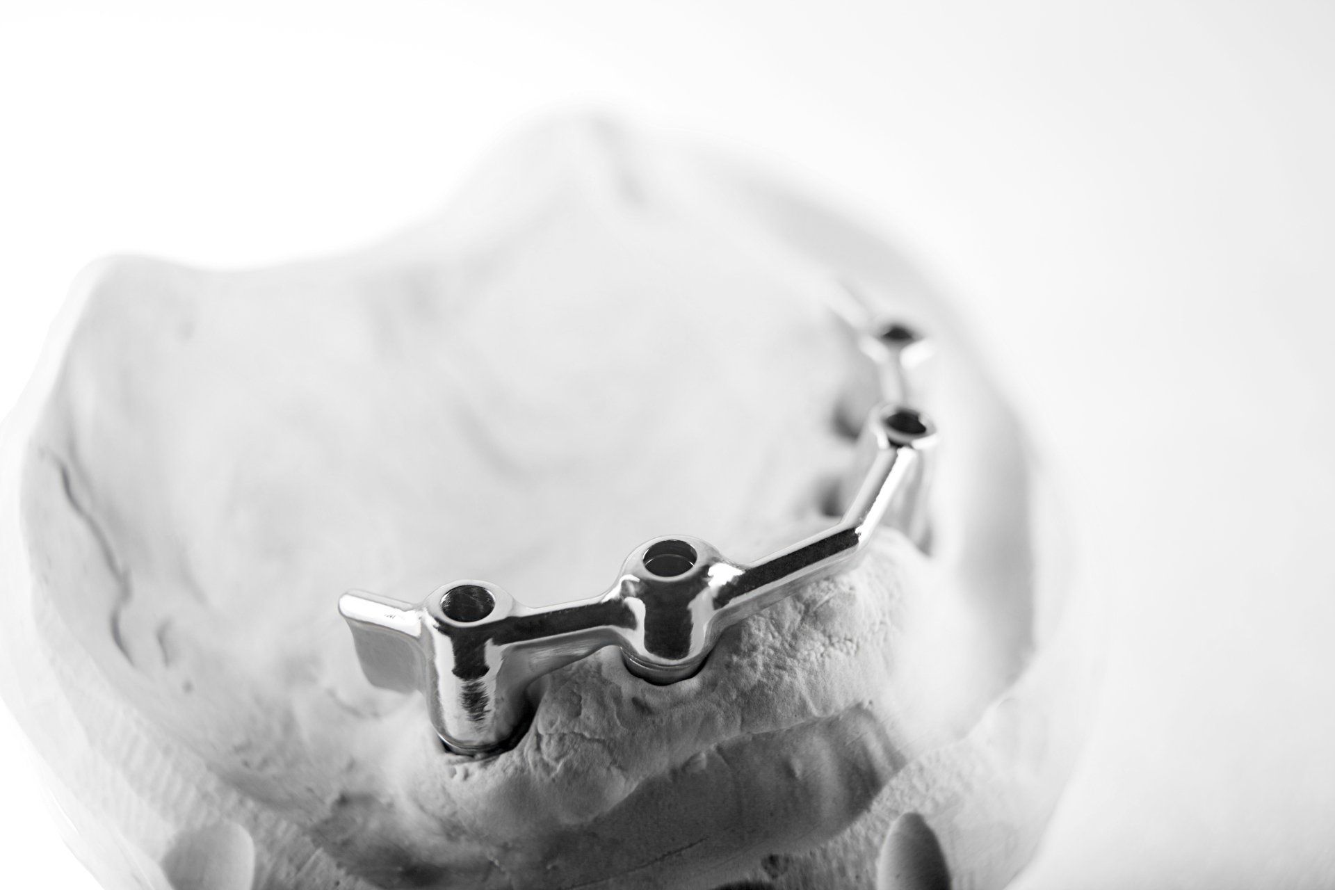 Barre d'Ackerman + stellite