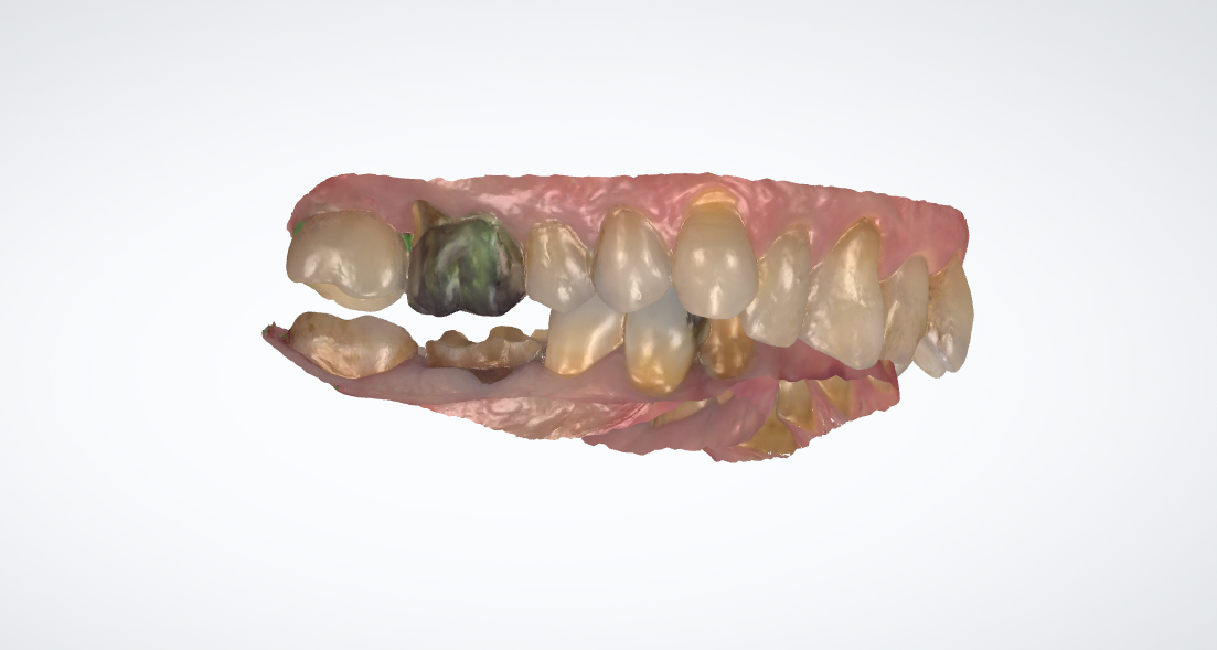 Enregistrement occlusion optique
