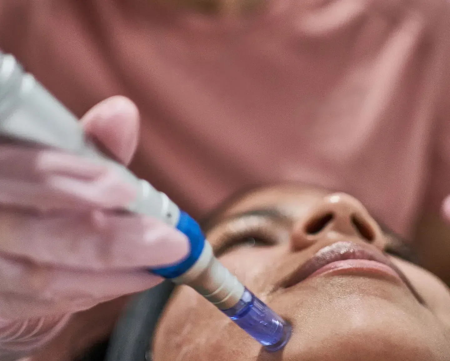 Una mujer está recibiendo un tratamiento facial con un bolígrafo en su cara.