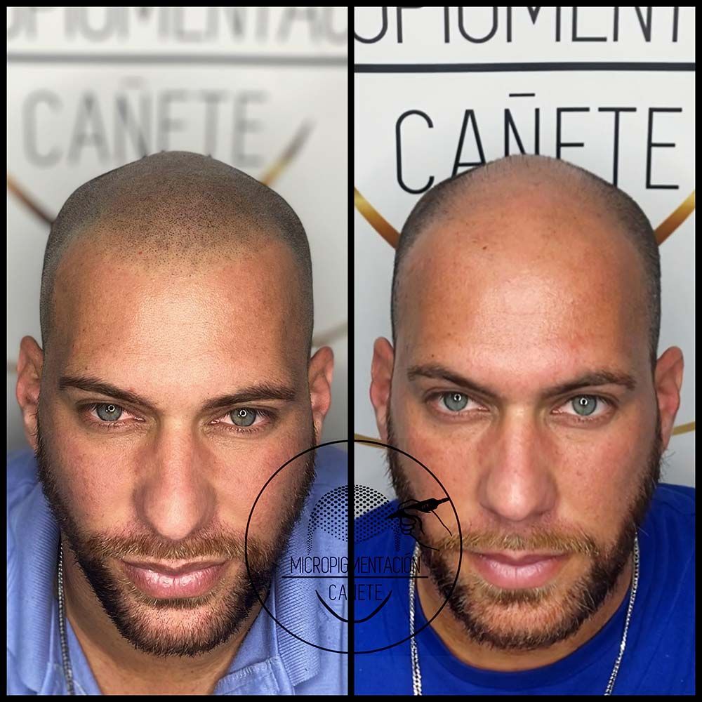 Comparación de cabeza calva: lado izquierdo con micropigmentación capilar, lado derecho sin ella. Hombre con barba y ojos claros.