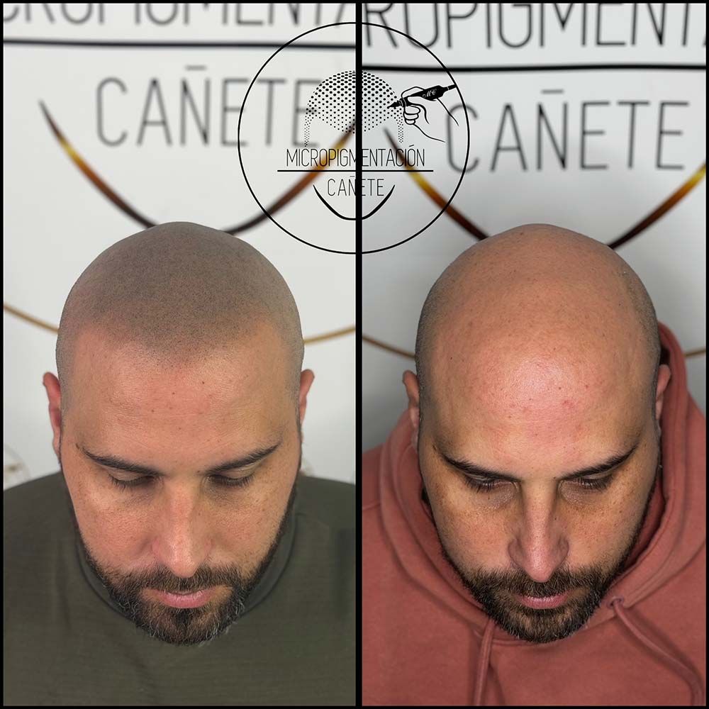 Dos cabezas calvas una al lado de la otra, una con micropigmentación del cuero cabelludo y la otra antes.