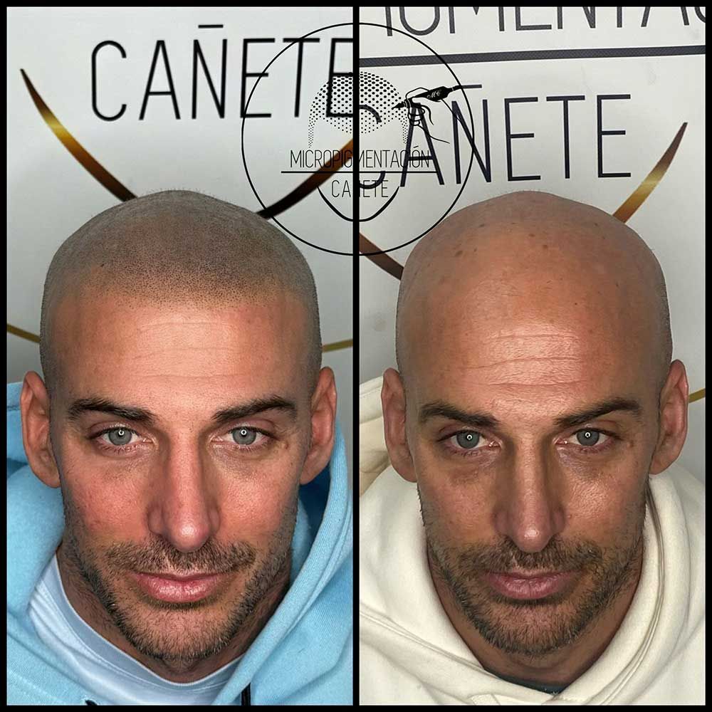Comparación de la cabeza de una persona antes y después de la micropigmentación del cuero cabelludo.