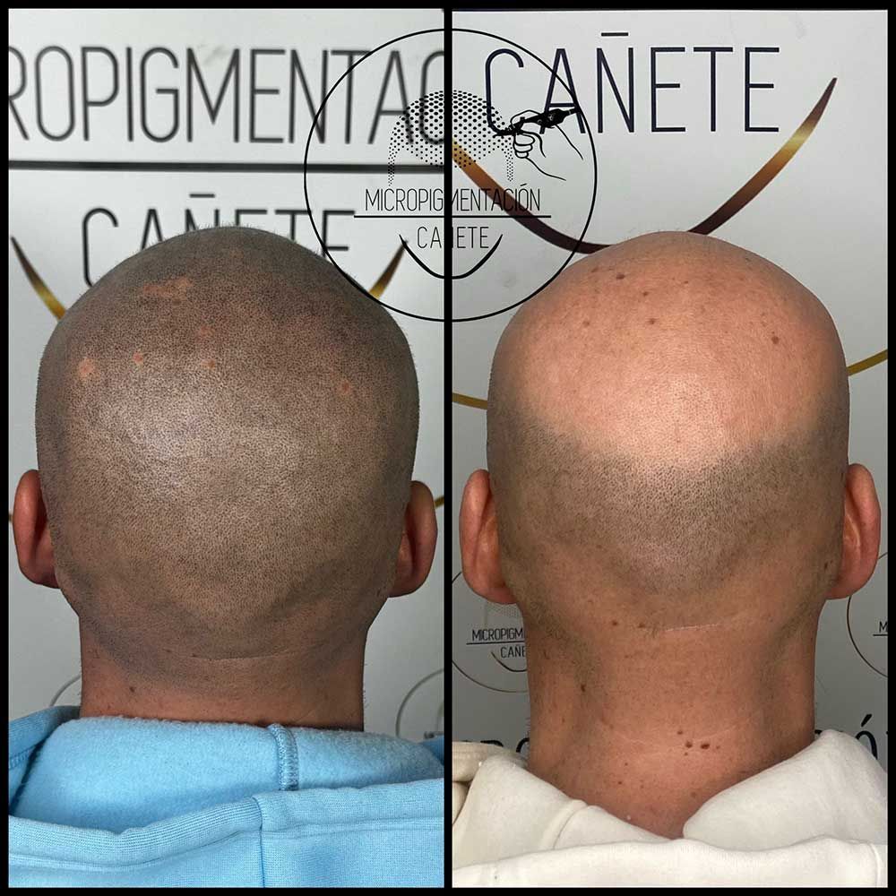 Comparación de una cabeza calva antes (derecha) y después (izquierda) del tratamiento de micropigmentación del cuero cabelludo.