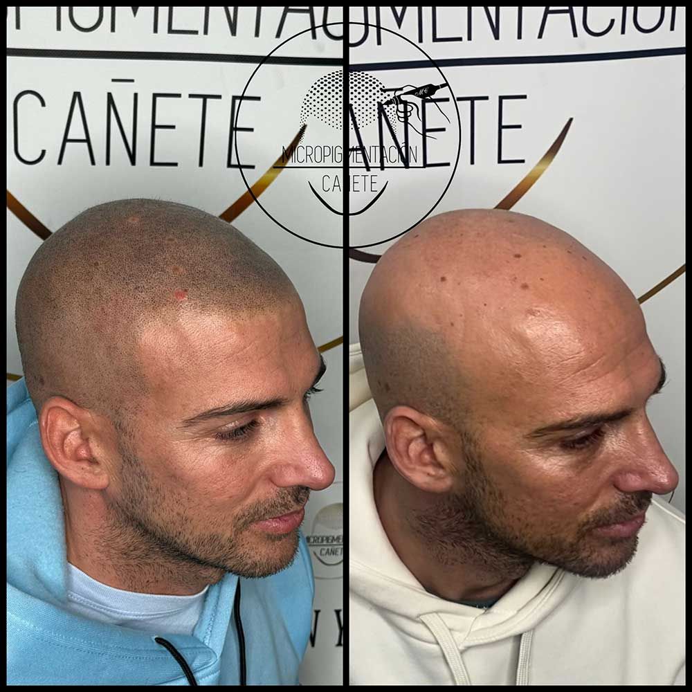 Dos fotografías, una al lado de la otra, de la cabeza de un hombre, antes y después del tratamiento de micropigmentación del cuero cabelludo.