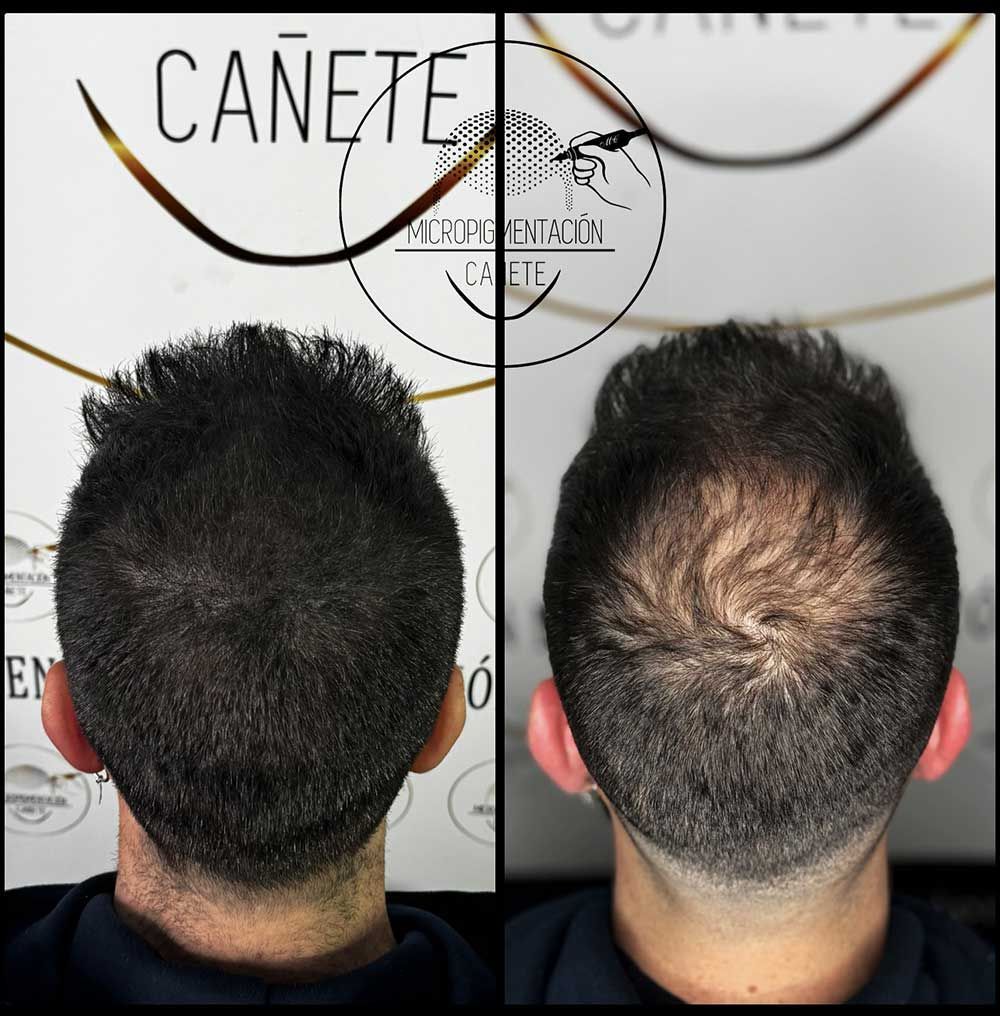 Vista del antes y el después de la cabeza de una persona, mostrando pérdida de cabello. El lado derecho tiene el cabello más corto y rapado.