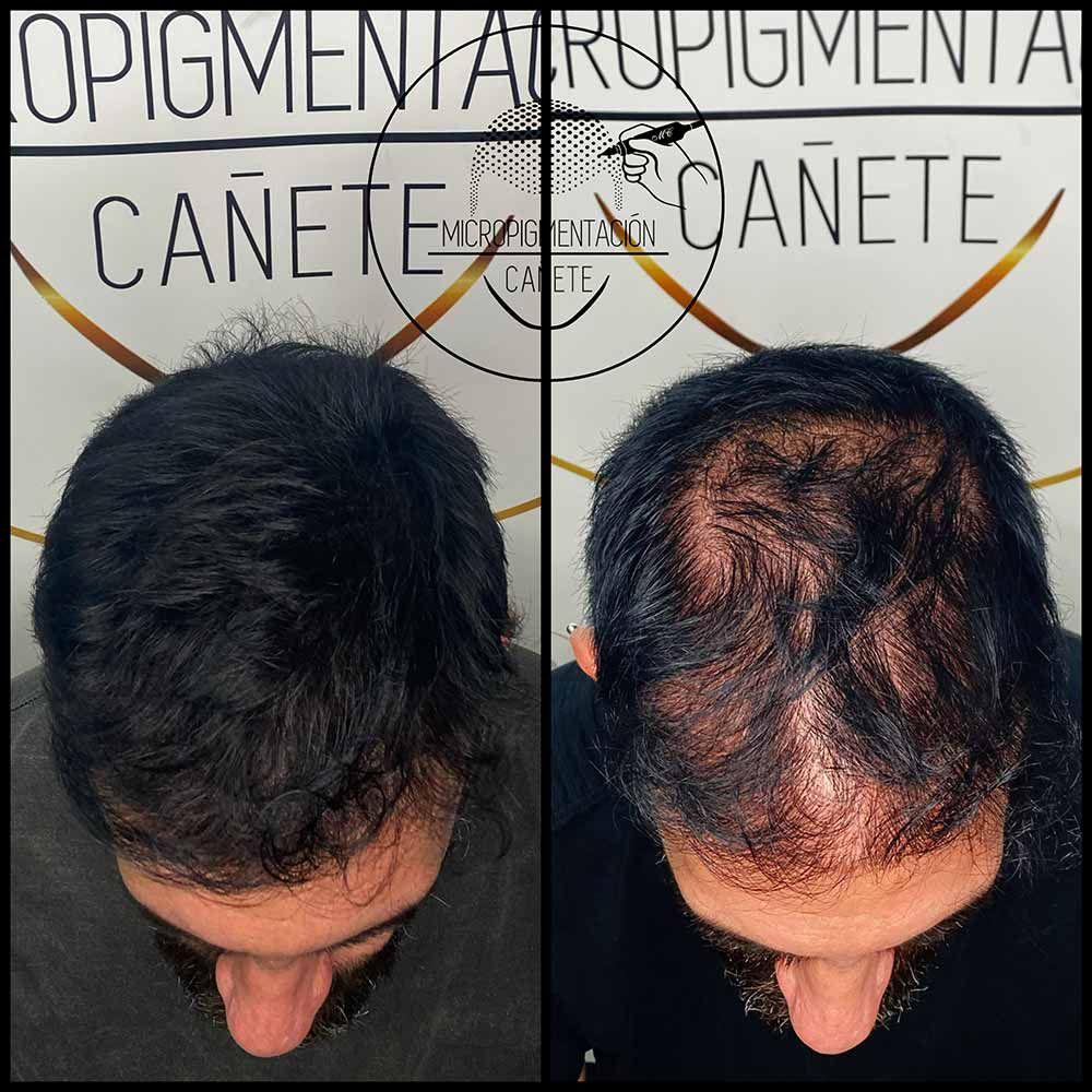 Imágenes de antes y después de un cuero cabelludo con cabello, mostrando el tratamiento para la caída del cabello.