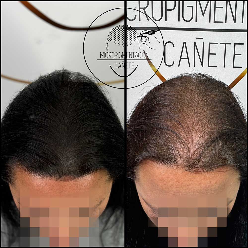 Comparación antes y después de la micropigmentación del cuero cabelludo en la cabeza de una persona, que muestra el cambio en la densidad del cabello.