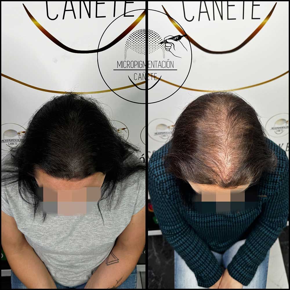 Comparación del antes y el después del trasplante capilar. Dos personas con cabello fino; una con cabello denso y oscuro después del tratamiento.