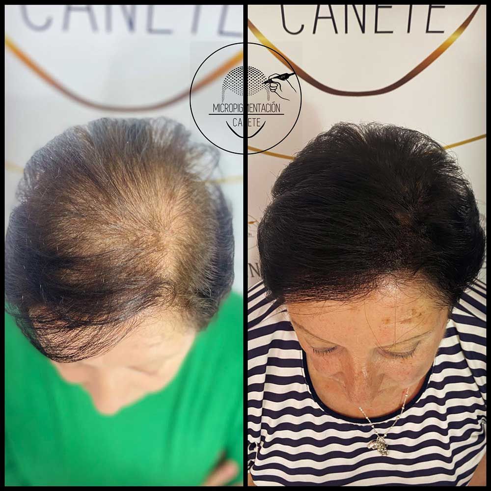 Comparación del cuero cabelludo de una mujer antes y después de un procedimiento capilar, mostrando el crecimiento y la cobertura del cabello.