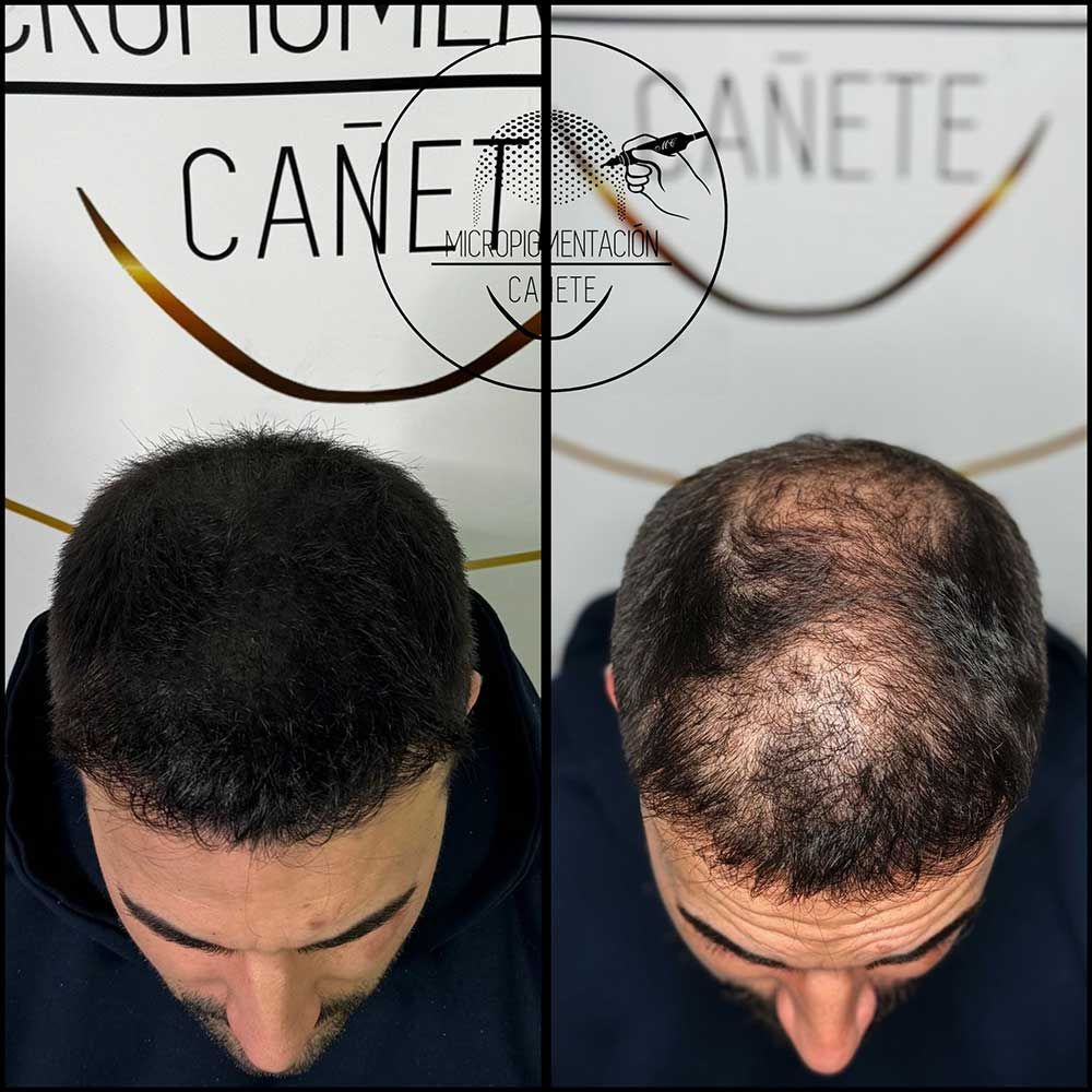 Comparación del cuero cabelludo de un hombre: antes con cabello oscuro, después con cabello ralo y cuero cabelludo visible.