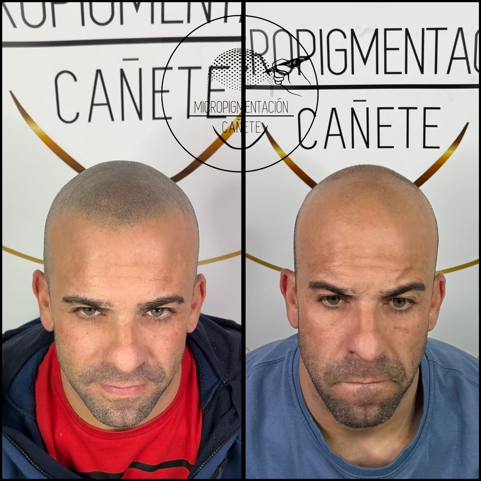 Antes y después de la micropigmentación capilar en un hombre. Izquierda: cuero cabelludo pigmentado. Derecha: antes de la pigmentación.
