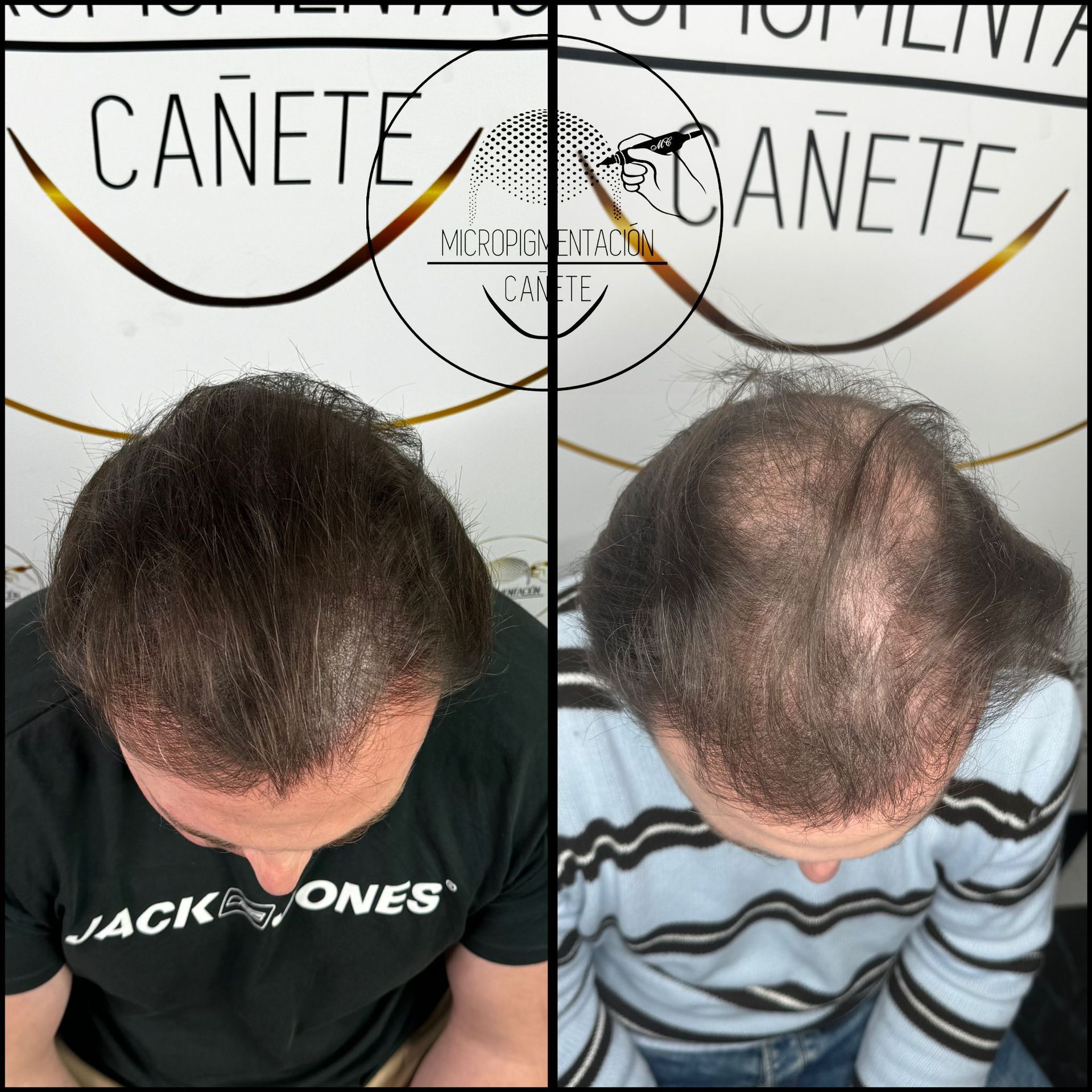 Dos vistas aéreas de la cabeza de un hombre, antes y después de la restauración capilar, frente al logo de