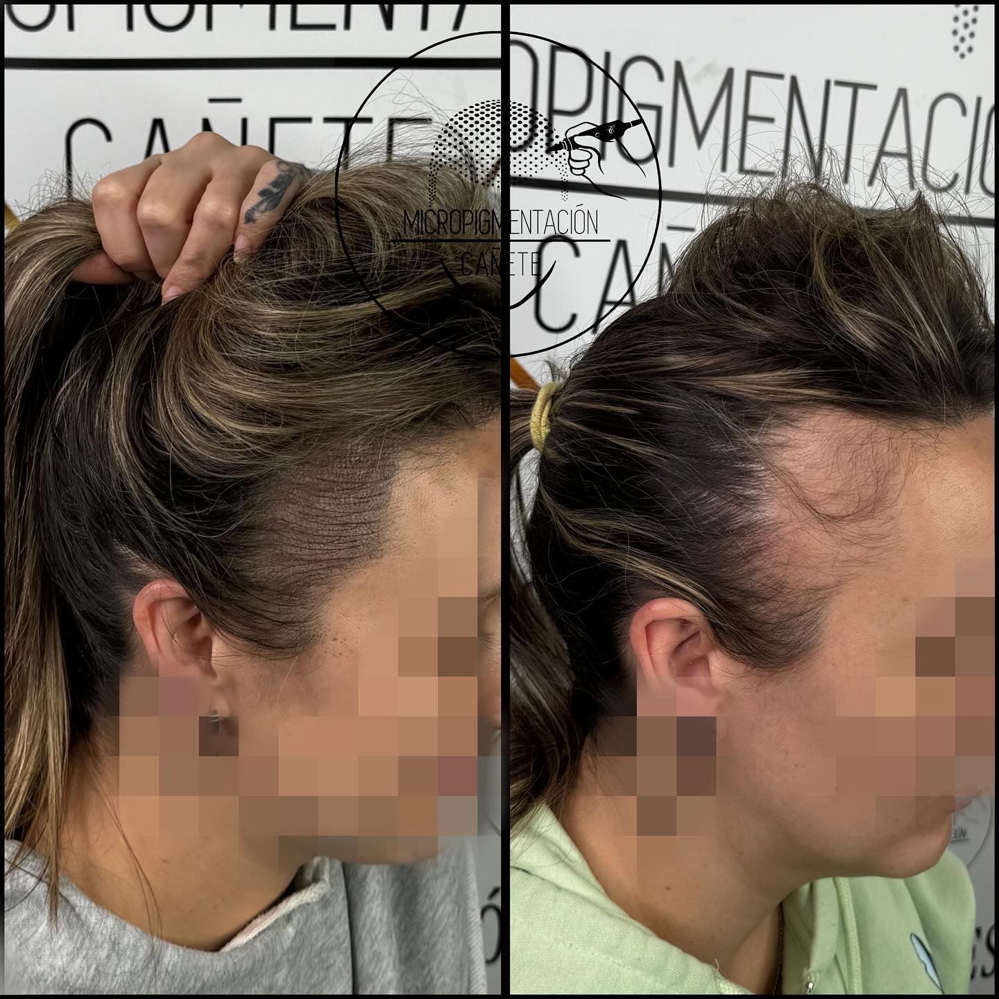 Comparación de la línea capilar de una mujer antes y después del procedimiento. Se observa la caída y el recrecimiento del cabello.