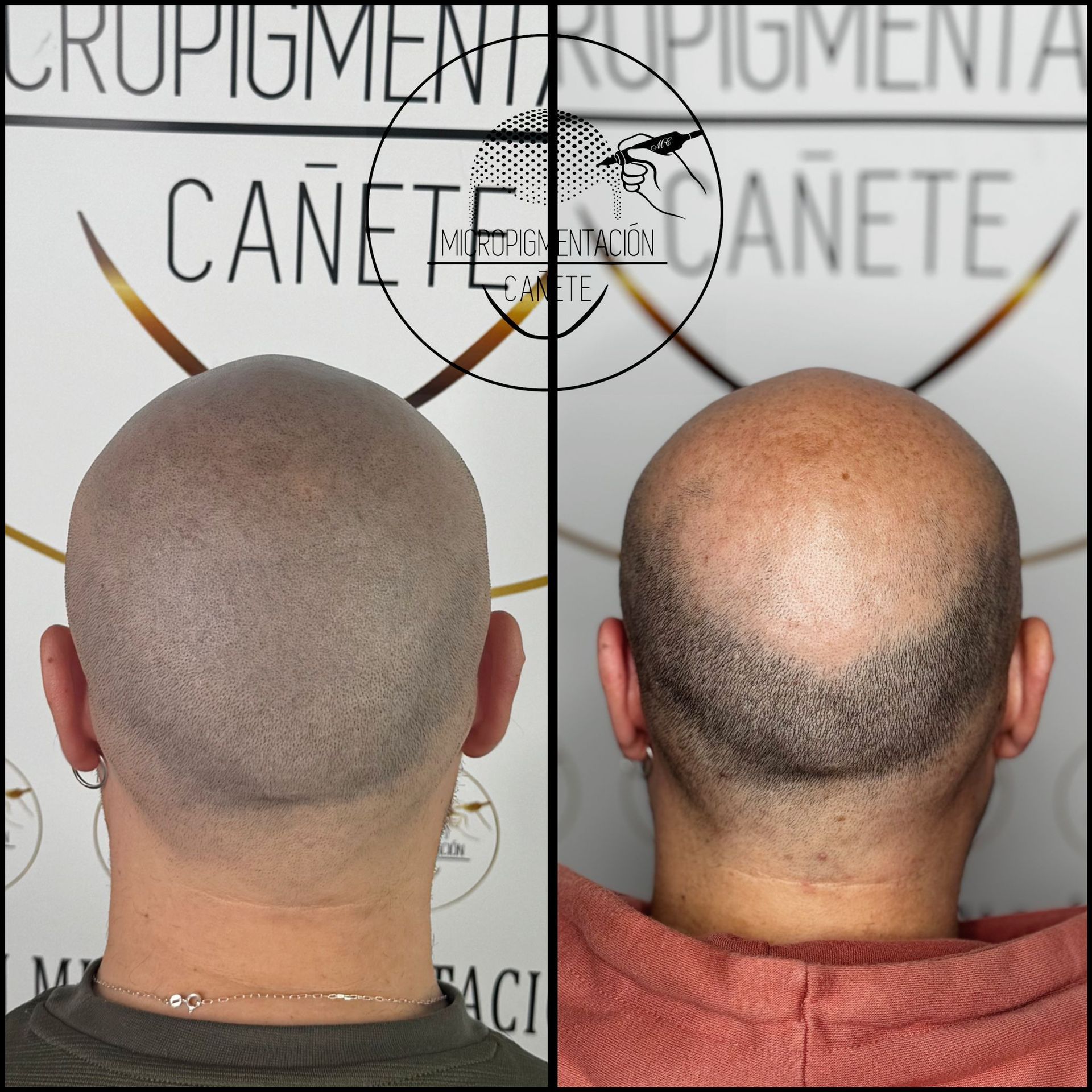 Comparación de un procedimiento de micropigmentación del cuero cabelludo; antes y después.
