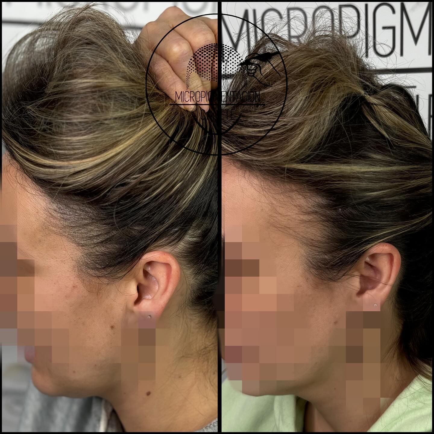 Antes y después de una línea de cabello, que muestra una apariencia más gruesa y abundante después del tratamiento de micropigmentación.