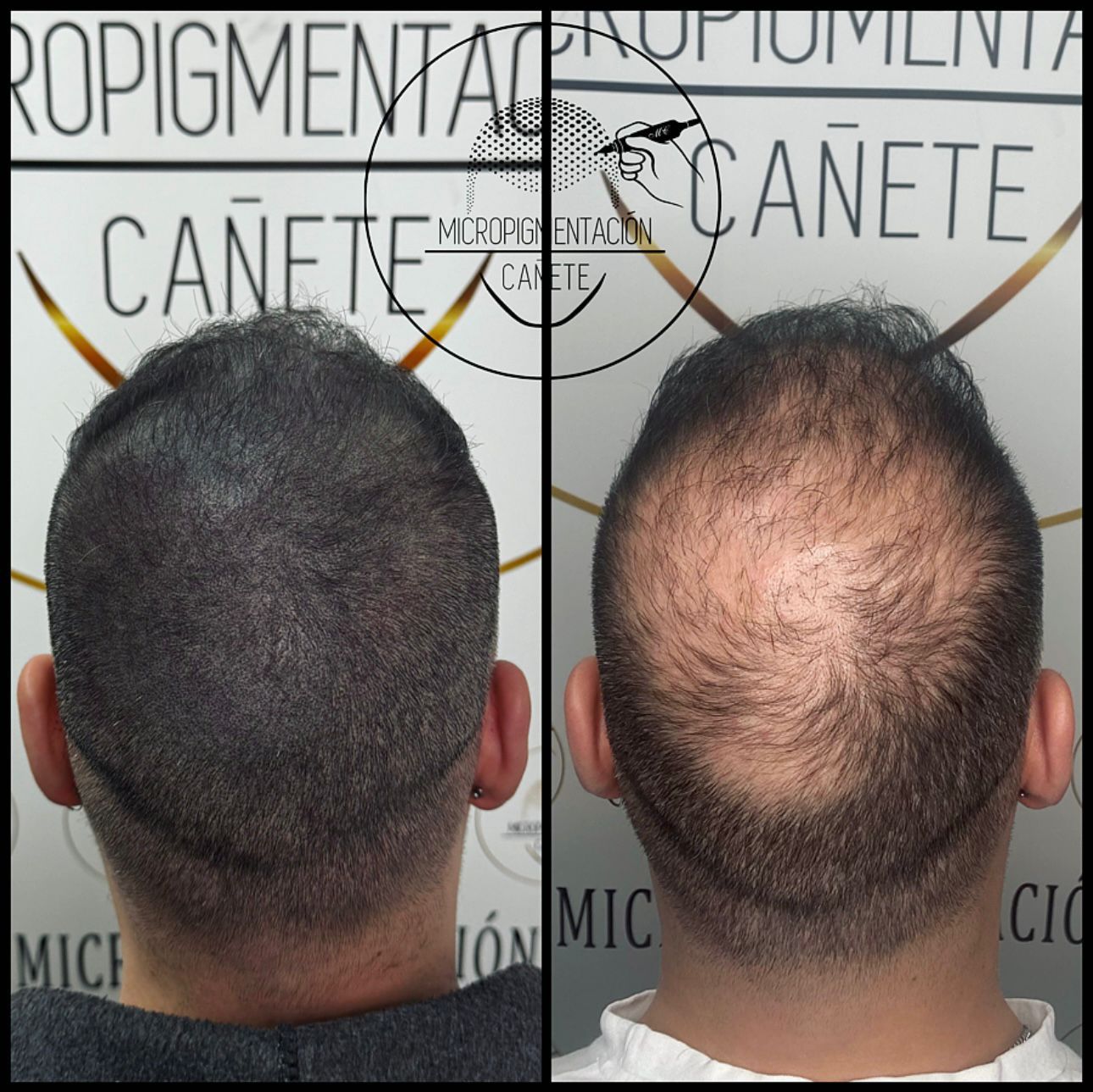 Dos vistas de una cabeza: antes y después de la micropigmentación capilar. La izquierda muestra un aspecto más oscuro y abundante. La derecha, cabello escaso.
