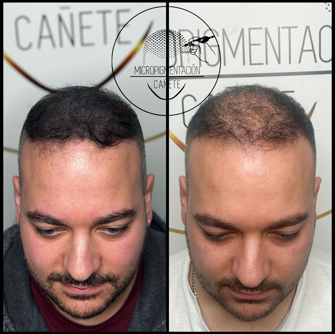 Fotografías de antes y después que muestran la micropigmentación del cuero cabelludo en la cabeza de un hombre, para abordar la pérdida de cabello.
