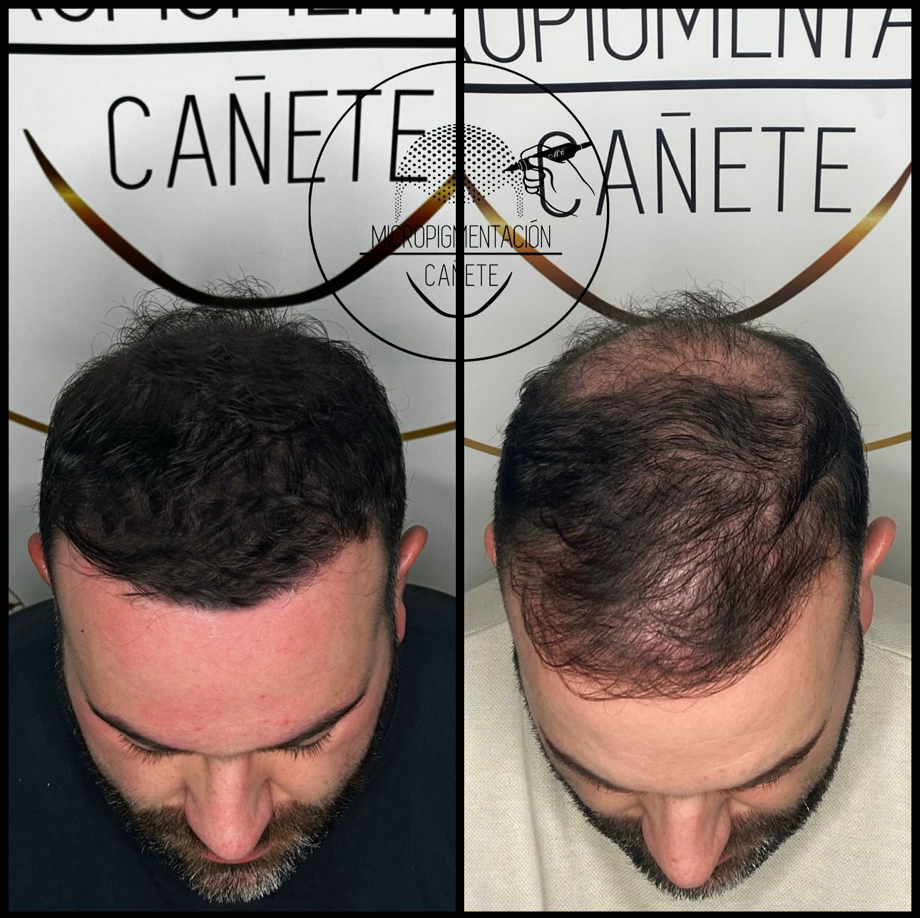 Comparación del cabello de un hombre antes y después de un trasplante capilar. El cabello luce más abundante después del procedimiento.