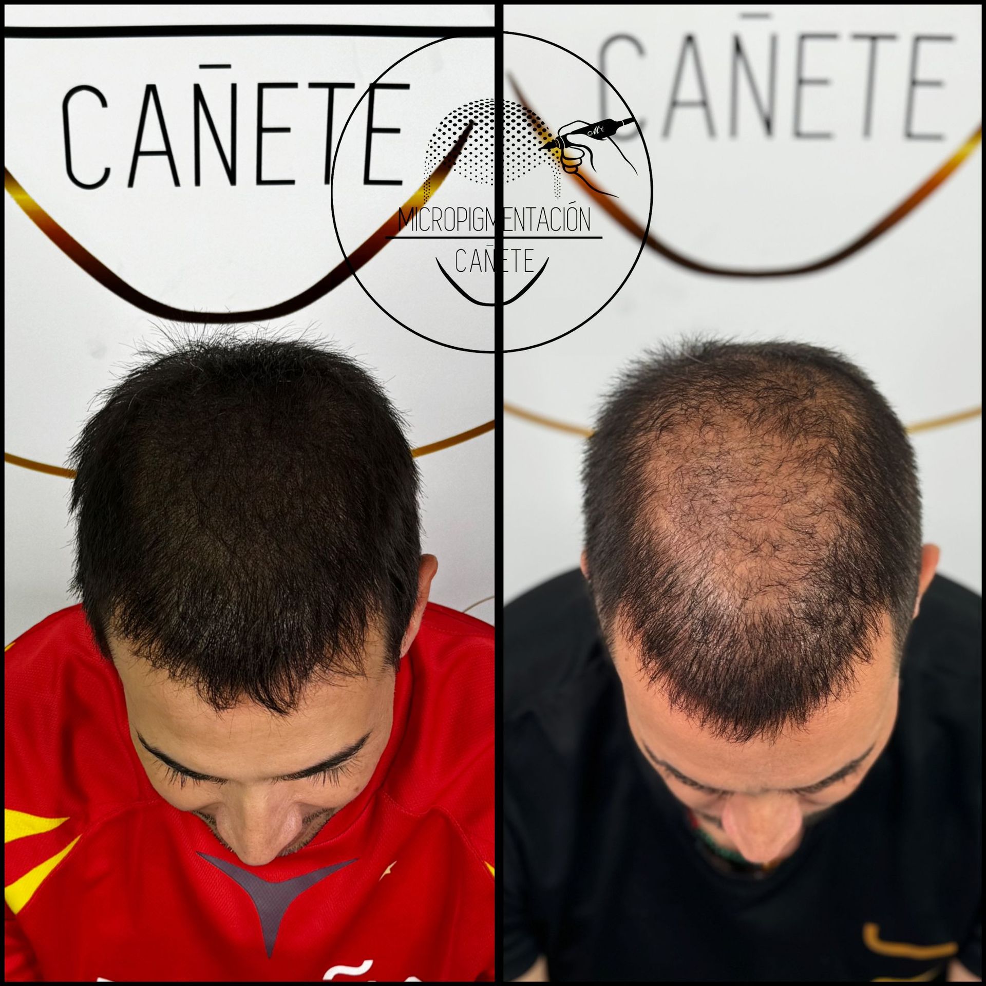 Comparación del cabello de una persona antes y después, mostrando la restauración capilar. La foto del