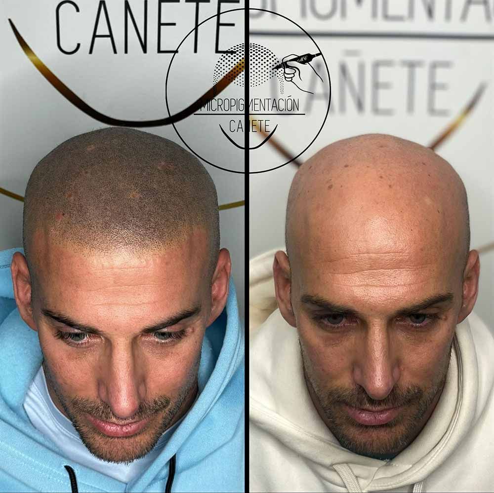 Antes y después de la micropigmentación del cuero cabelludo en la cabeza de un hombre, mostrando la simulación del folículo piloso.