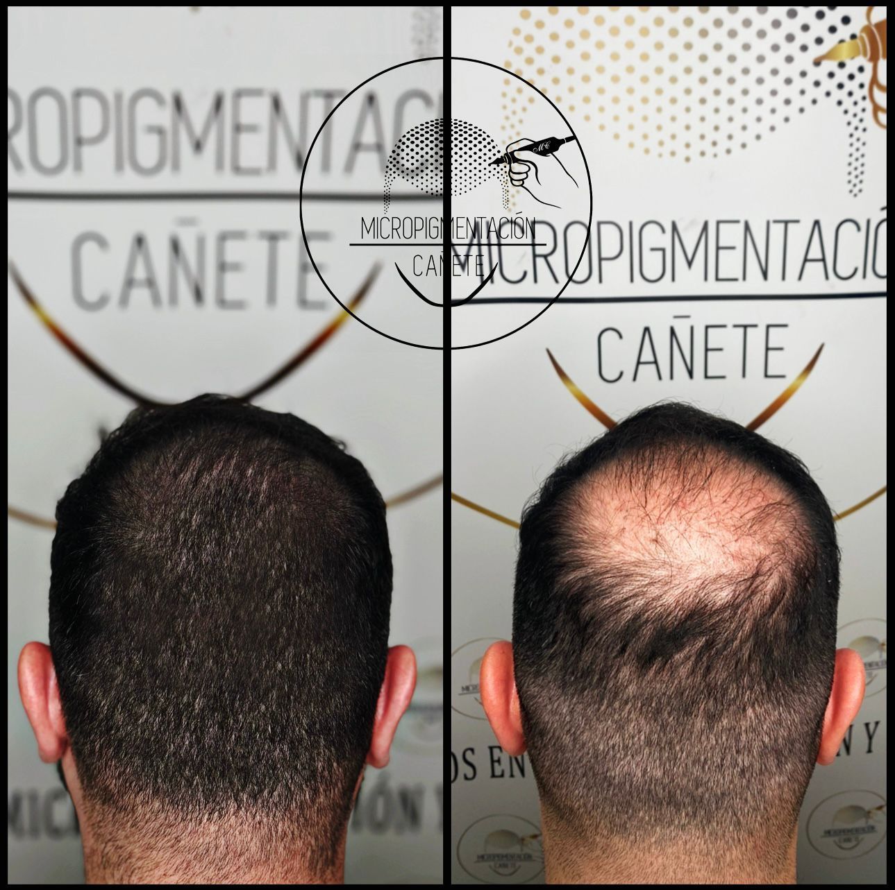 Comparación de un cuero cabelludo antes y después de la micropigmentación capilar.