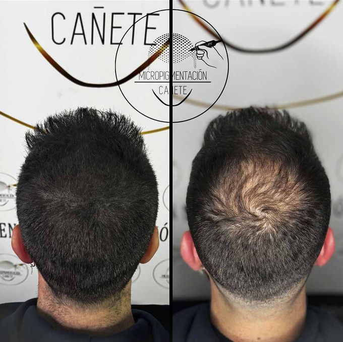 Comparación de una cabeza rapada antes y después de un tratamiento de micropigmentación capilar.