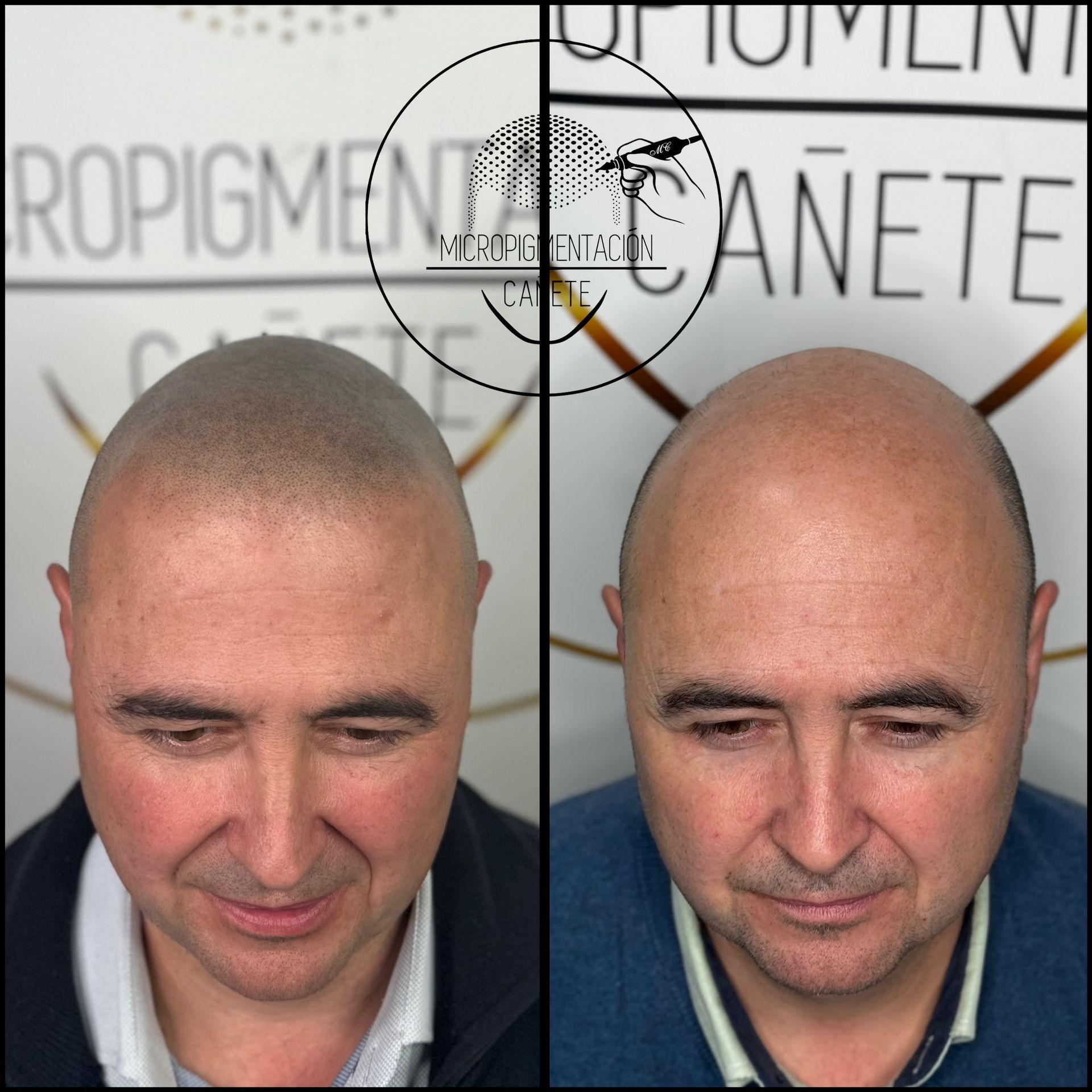 Micropigmentación capilar antes y después. Hombre calvo con puntos de pigmento a la izquierda, piel lisa a la derecha.