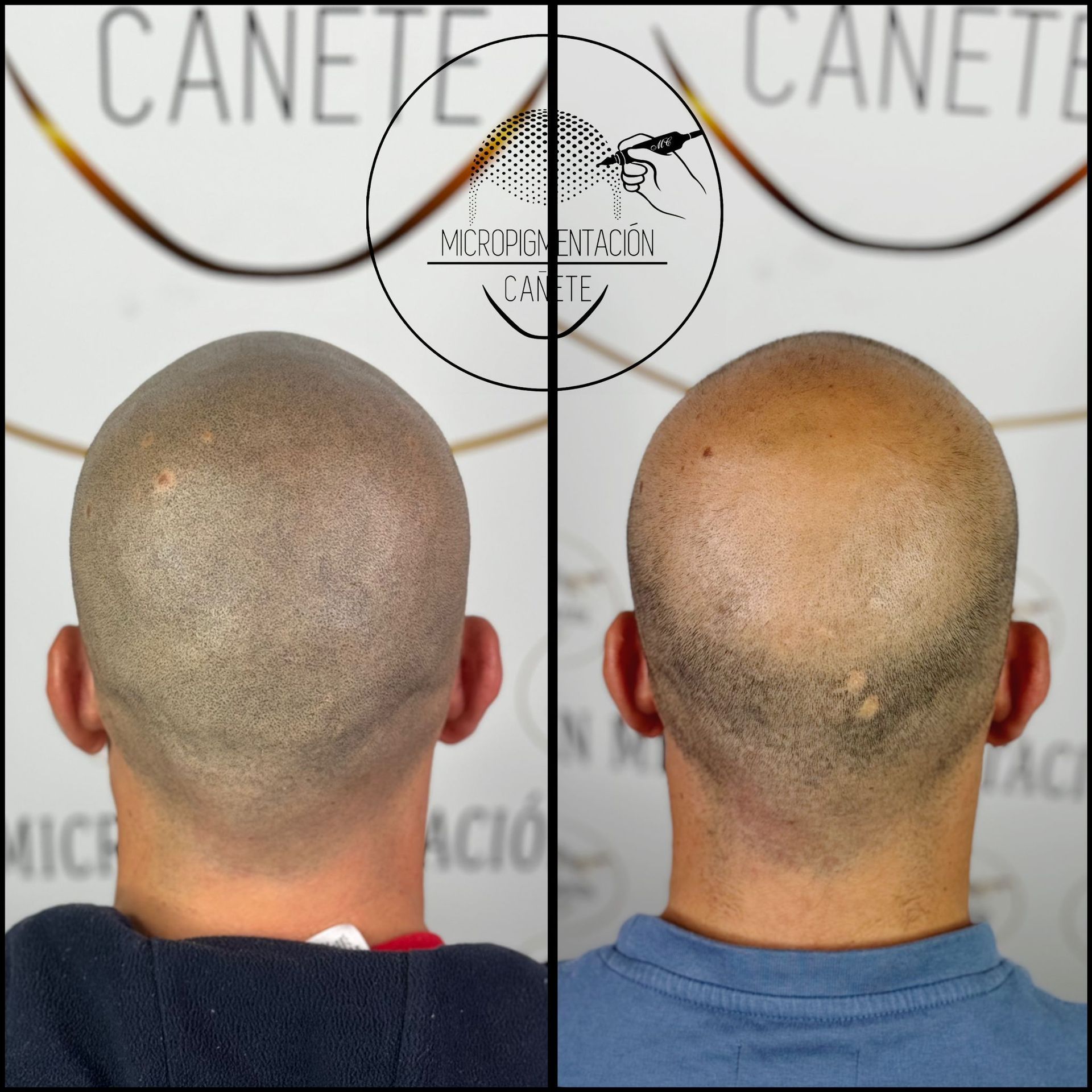 Micropigmentación del cuero cabelludo antes y después, mostrando la simulación del folículo piloso para una cabeza calva.