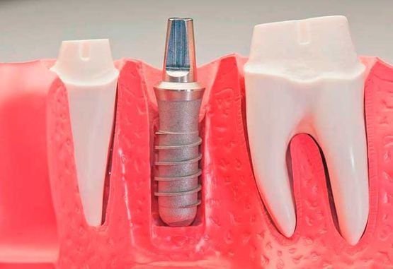 Corte transversal de los dientes que muestra un implante dental entre dos raíces dentales blancas y tejido gingival rosado.