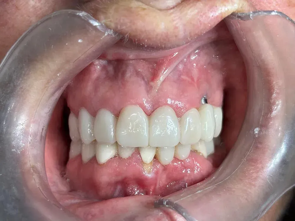 Un primer plano de la boca de una persona con un protector bucal transparente.