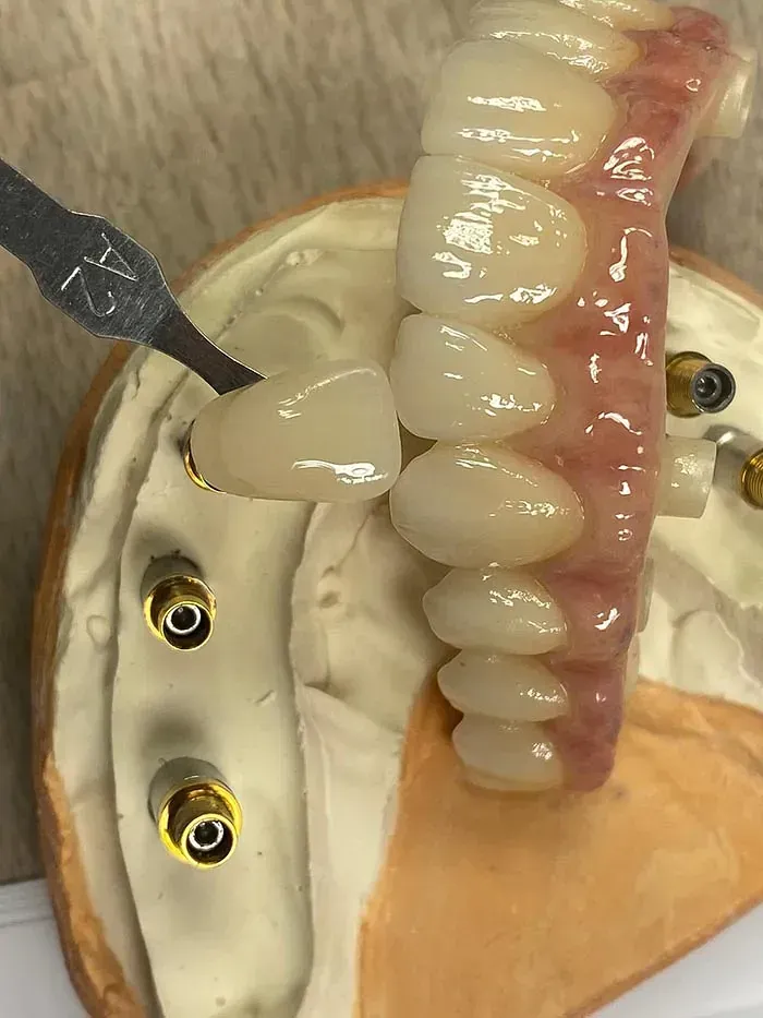 Un primer plano de un modelo dental del cual se extrae un diente.