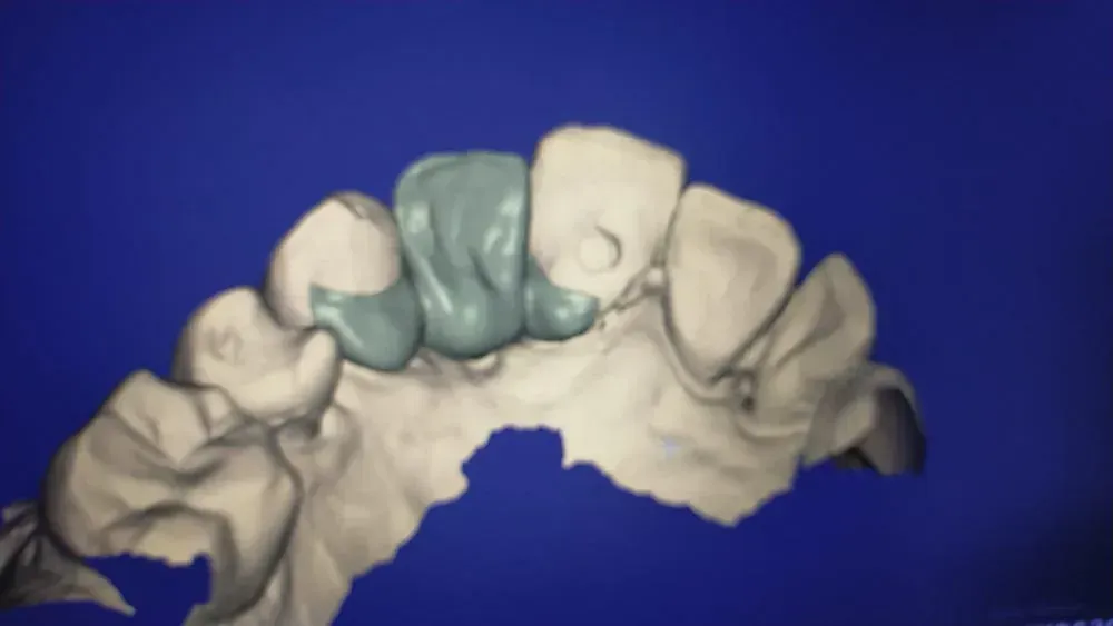 Un modelo 3D de los dientes de una persona sobre un fondo azul.