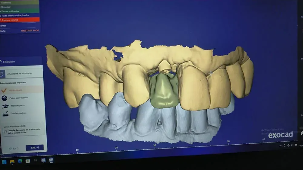 Una pantalla de computadora muestra un modelo 3D de los dientes de una persona.
