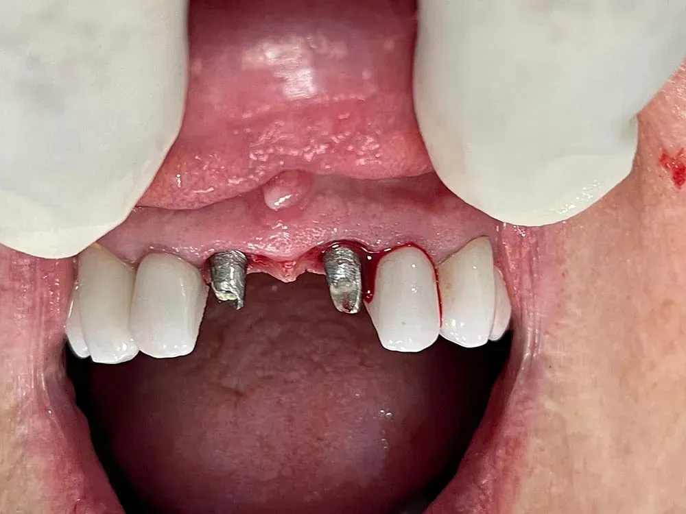 Un primer plano de la boca de una persona con un diente roto.