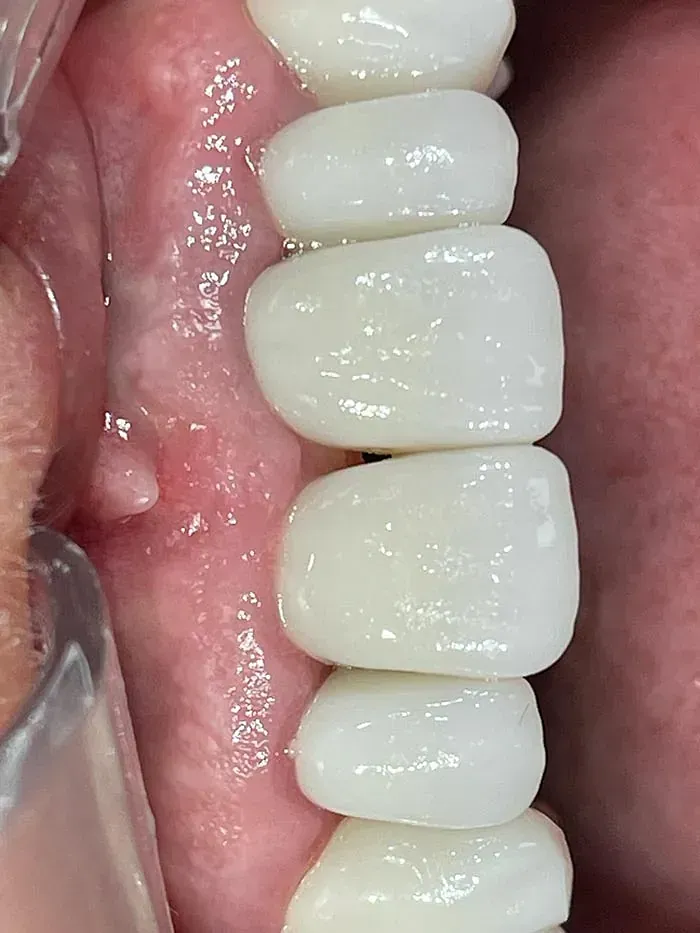 Un primer plano de los dientes de una persona con un agujero en el medio.