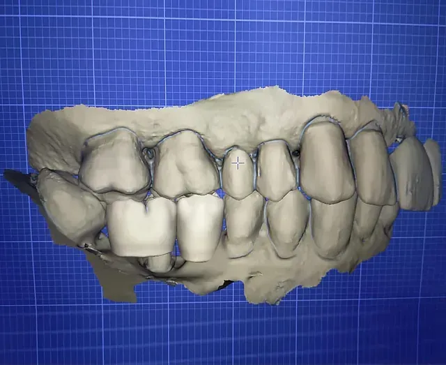 Un modelo 3D de los dientes de una persona sobre un fondo azul.