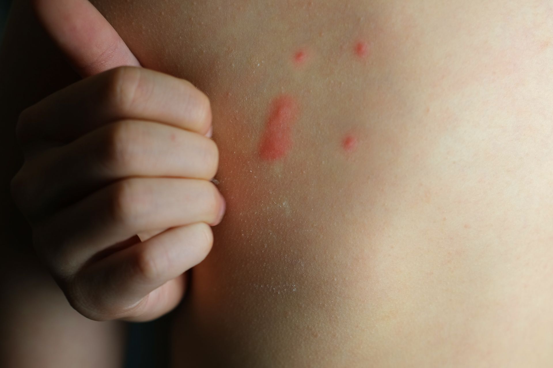 Main pointant une éruption cutanée rouge sur le torse.