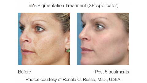 trattamento pigmentazione elos