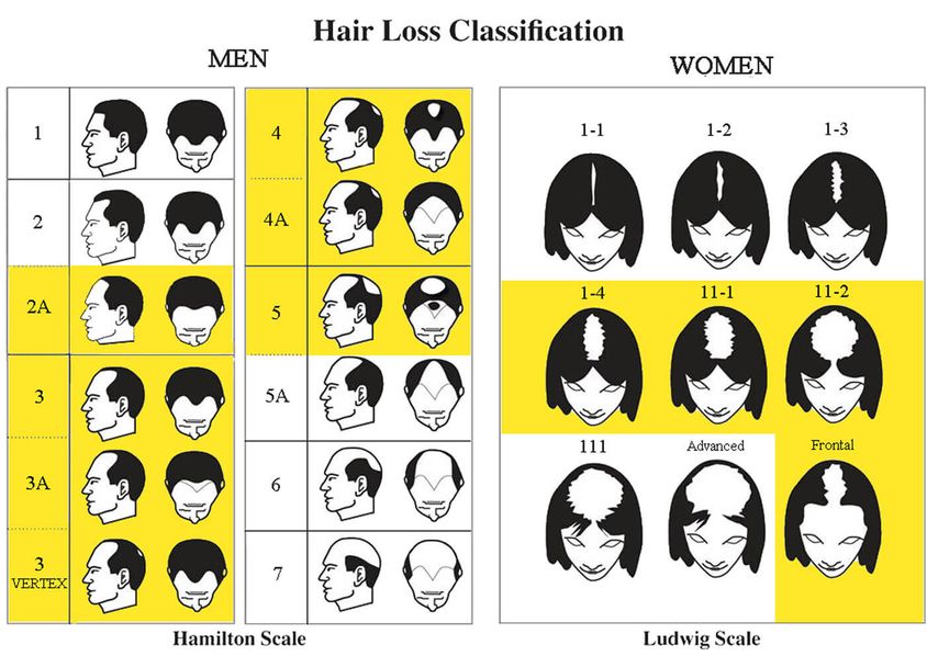 hair loss - tabella perdita capelli