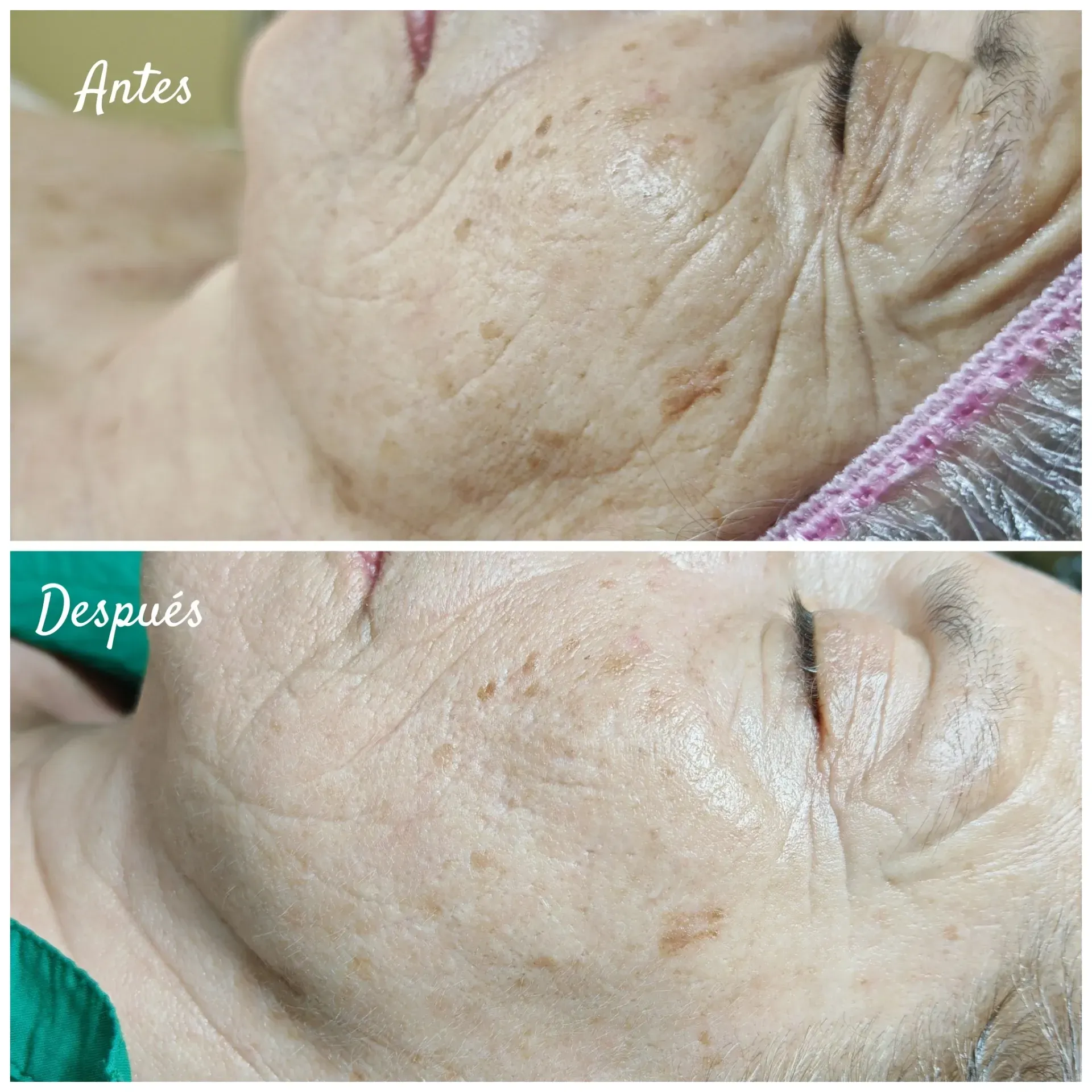 Comparación del rostro antes y después del tratamiento, mostrando reducción de arrugas y manchas.