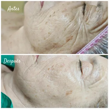 Comparación del rostro antes y después del tratamiento, mostrando reducción de arrugas y manchas.