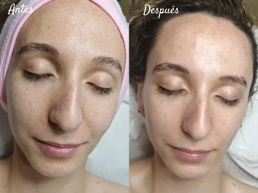 Tratamiento facial antes y después; mujer con la piel más clara y luminosa. Un lado muestra la piel más áspera, el otro, más suave.